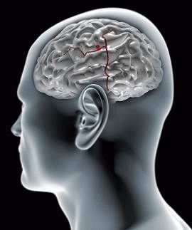 Лечение сосудистых мальформаций в головном мозге в Израиле