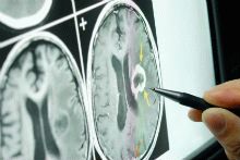 Возможно ли определить риск возникновения метастазов в головном мозге?