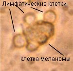 лечение меланомы и рака кожи на разных стадиях