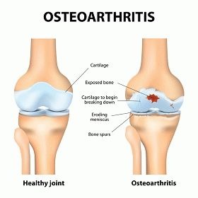 как определить остеоартрит