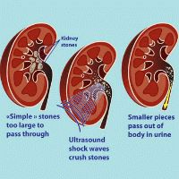 Литотрипсия в Израиле. Дробление камней в почках ультразвуком