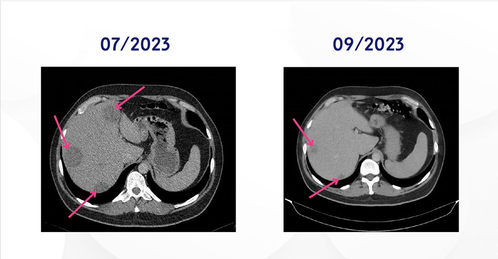 til-melanoma-treatment-success-rate.png